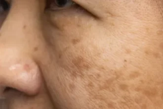 Actinic Keratosis