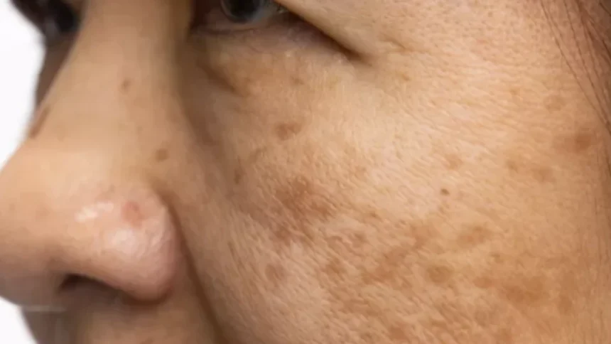 Actinic Keratosis