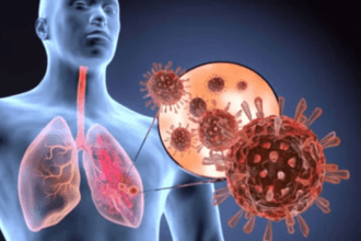 Acute Respiratory Distress Syndrome