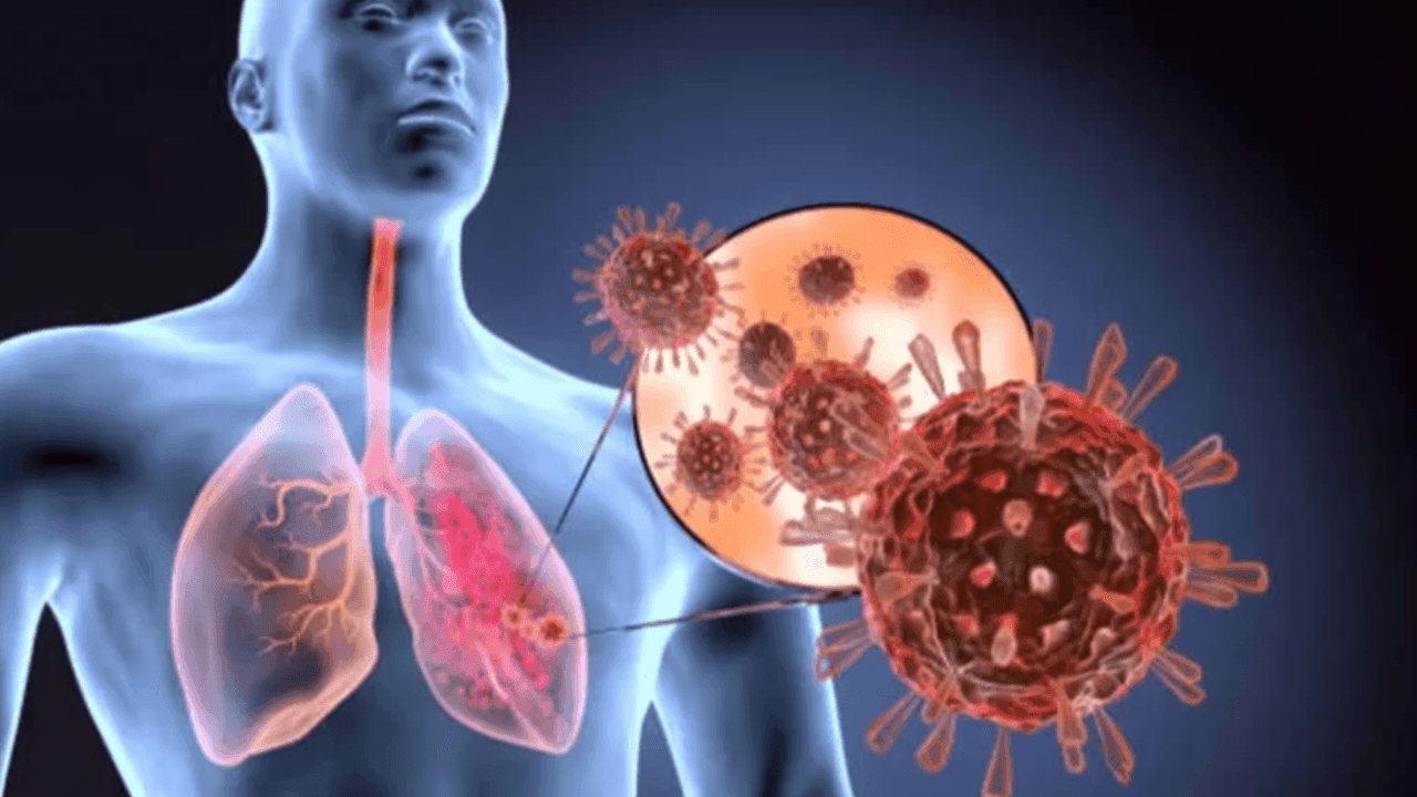 Acute Respiratory Distress Syndrome