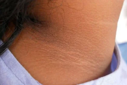 Acanthosis Nigricans