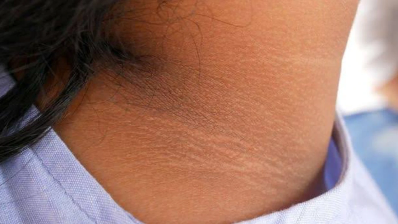 Acanthosis Nigricans