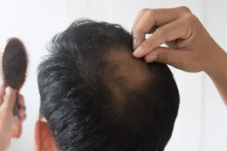 Alopecia Areata