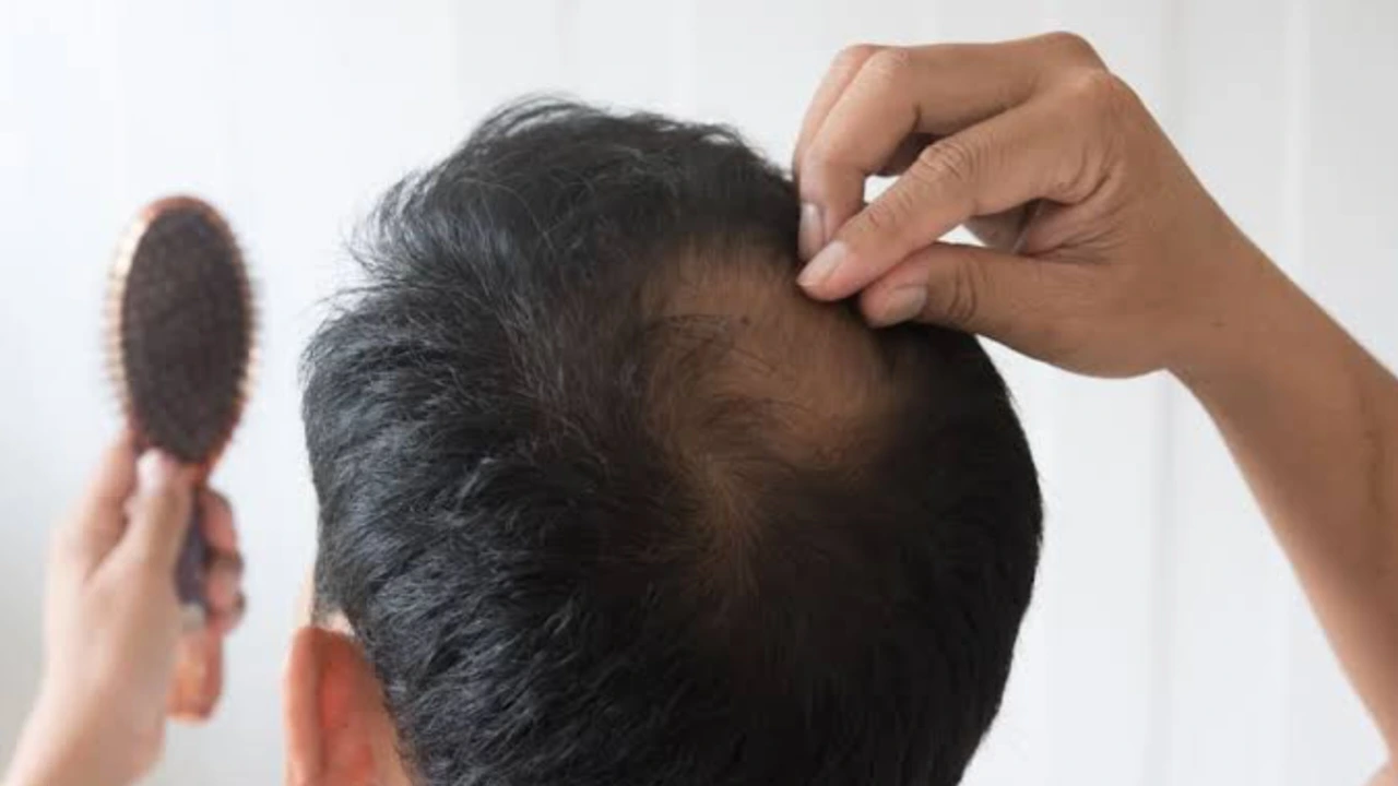 Alopecia Areata