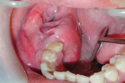 Ameloblastoma